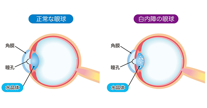 白内障の説明