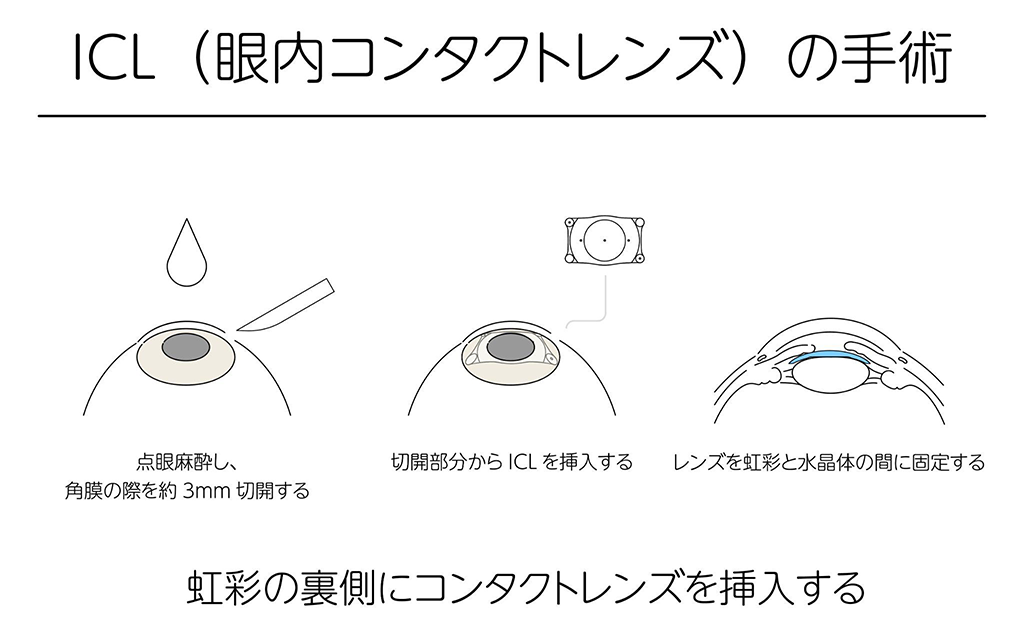 ICLの手術